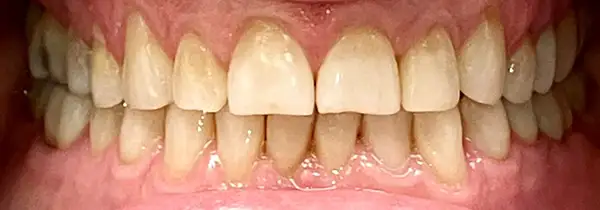 Invisalign Before & After Smile Gallery