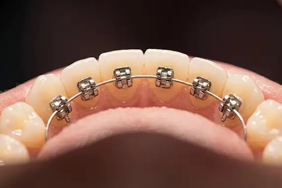 Lingual Braces