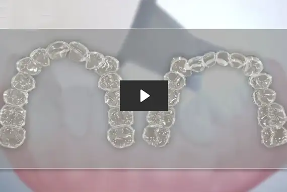 A smiling person wearing clear aligners, showcasing teeth alignment.