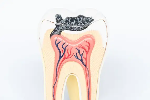 Cavity Detection System
