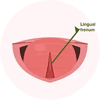 Tongue-Tie Treatment