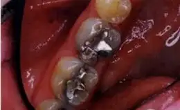 Ceramic Inlays & Onlays Before & After Smile Gallery
