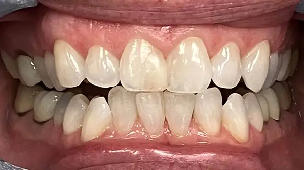 Invisalign Before & After Smile Gallery