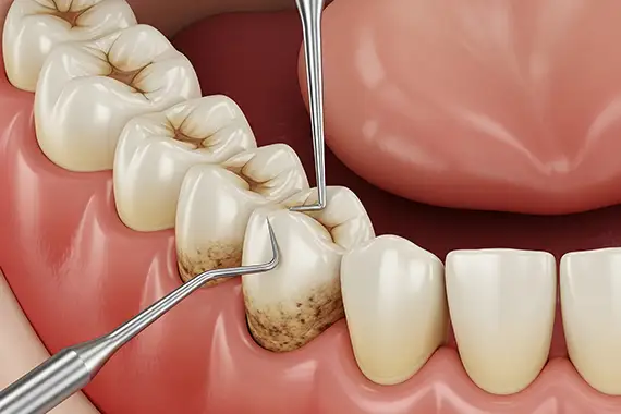 Scaling and Root Planing (Deep Cleaning)
