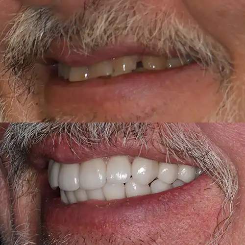 Before & After Gallery image