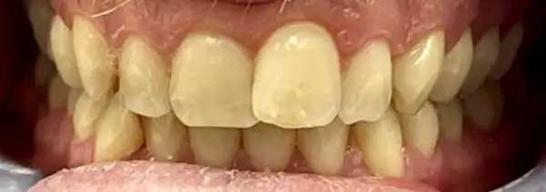 Invisalign Before & After Smile Gallery
