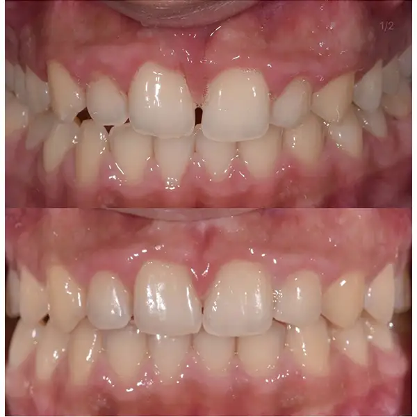 Invisalign Treatment Before & After