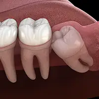 Impacted Tooth Exposure and Bonding