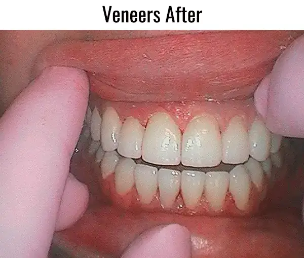 veneers after