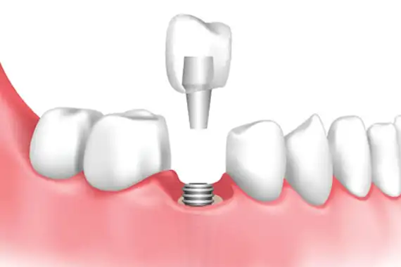 Dental implant