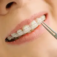 Ceramic / Clear Braces