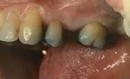 Bridges Before & After Smile Gallery 