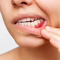Periodontal Maintenance