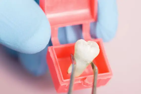 Tooth extraction
