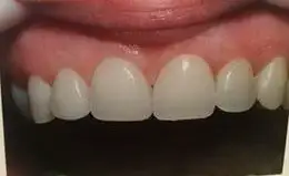 Dental Implants Before & After