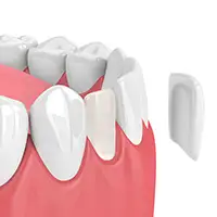3D Printed Veneers