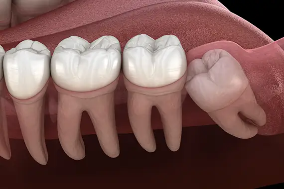 Impacted Tooth Exposure & Bonding