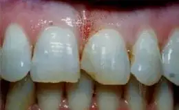 Bonding Before & After Smile Gallery