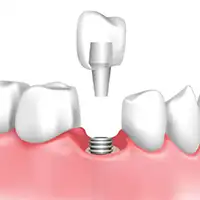 Implant Restorations