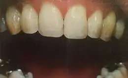 Veneers Before & After