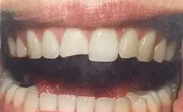 Bonding Before & After Smile Gallery