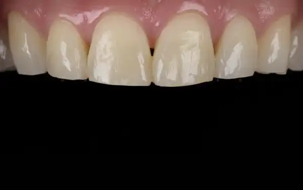 Before and After