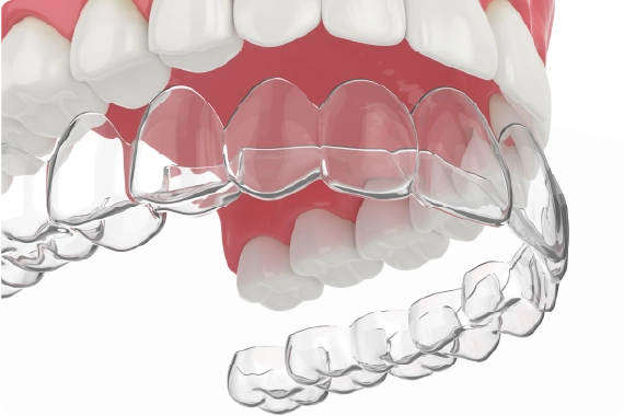 Clear aligners