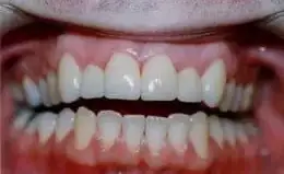 Veneers Before & After