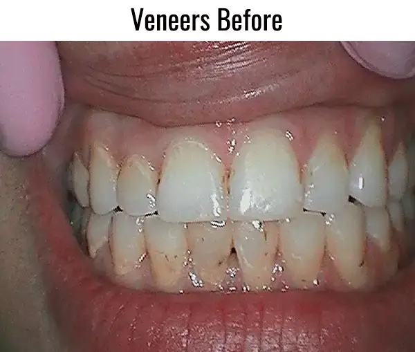 veneers before