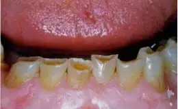 Veneers Before & After