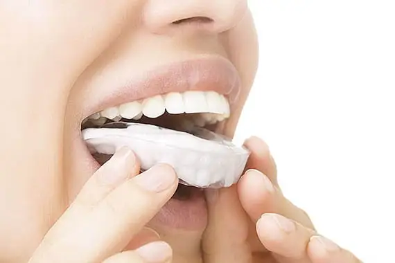 Custom night guard designed to protect teeth from grinding.