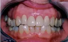 Crowns Before & After