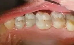 Crowns Before & After