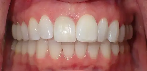 Before Smile and Bite