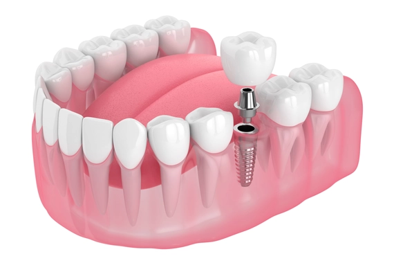 Dental implant