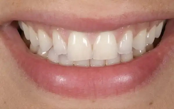 Before and After