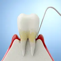 Scaling and Root Planing