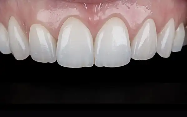 Before and After