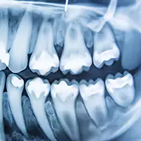 Digital Bitewing and Periapical X-Rays