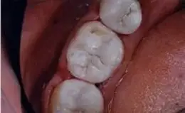 Ceramic Inlays & Onlays Before & After Smile Gallery