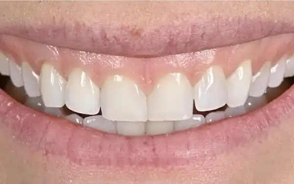 Before and After