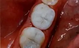 Ceramic Inlays & Onlays Before & After Smile Gallery