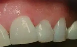Crowns Before & After