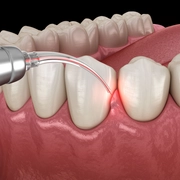 LANAP® Laser Gum Treatment 