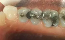 Ceramic Inlays & Onlays Before & After Smile Gallery
