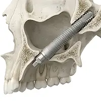 Zygomatic and Pterygoid Dental Implants