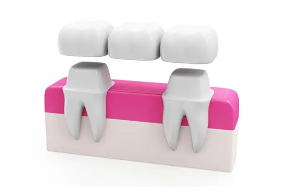 Dental bridge showcasing artificial teeth and supporting crowns.