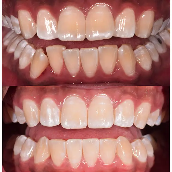 Invisalign Treatment Before & After