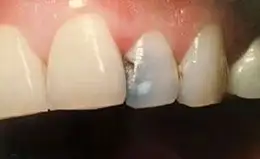 Crowns Before & After