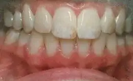 Whitening Before & After Smile Gallery